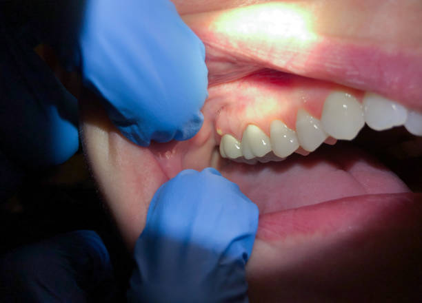 Best Broken or Cracked Tooth Emergency Dentist in Owens Cross Roads, AL